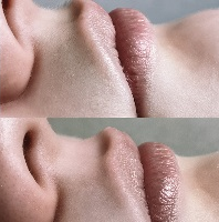 шугаринг верхней губы до и после